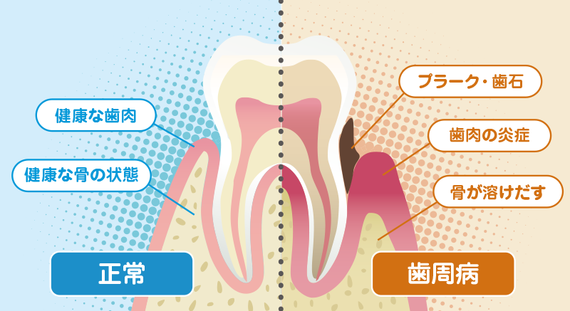 歯周病 歯槽膿漏 の治療 歯周病 歯槽膿漏 の治療 名古屋駅 名駅 の歯科 インプラント 矯正なら みやかわデンタルクリニック