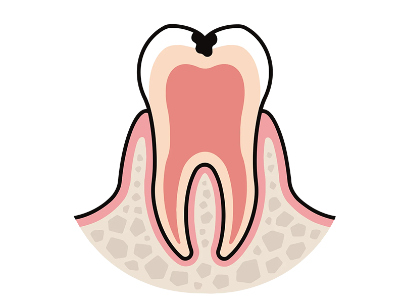象牙質まで及んだ虫歯/C2のイメージ