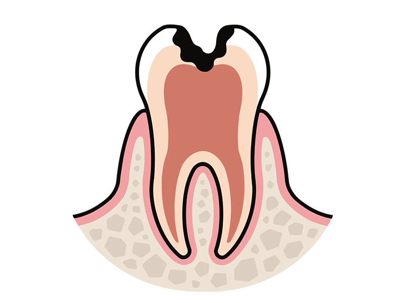 神経まで及んだ虫歯/C3のイメージ