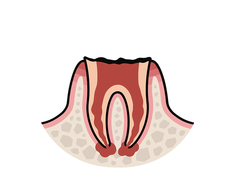 歯の根まで及んだ虫歯/C4のイメージ